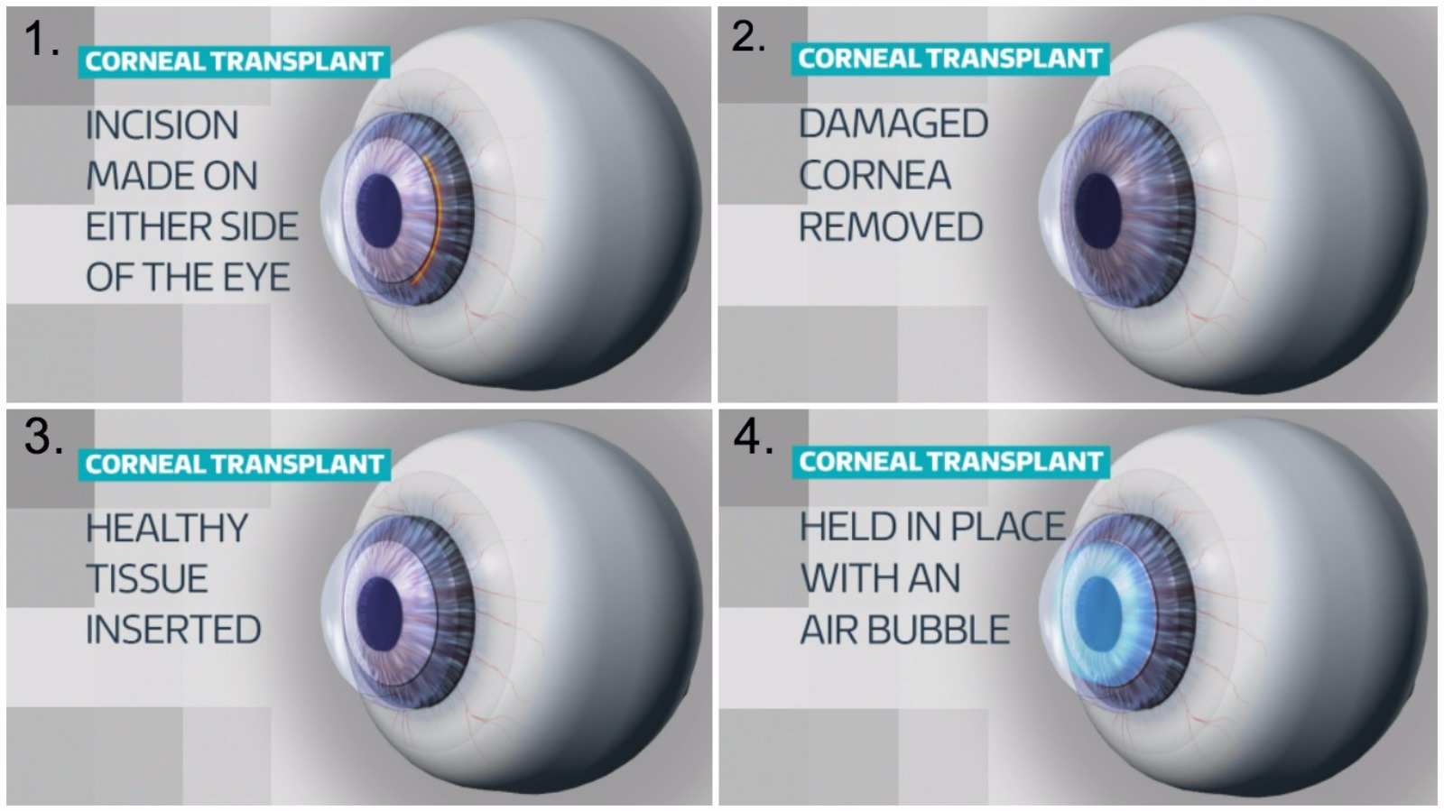 cataract